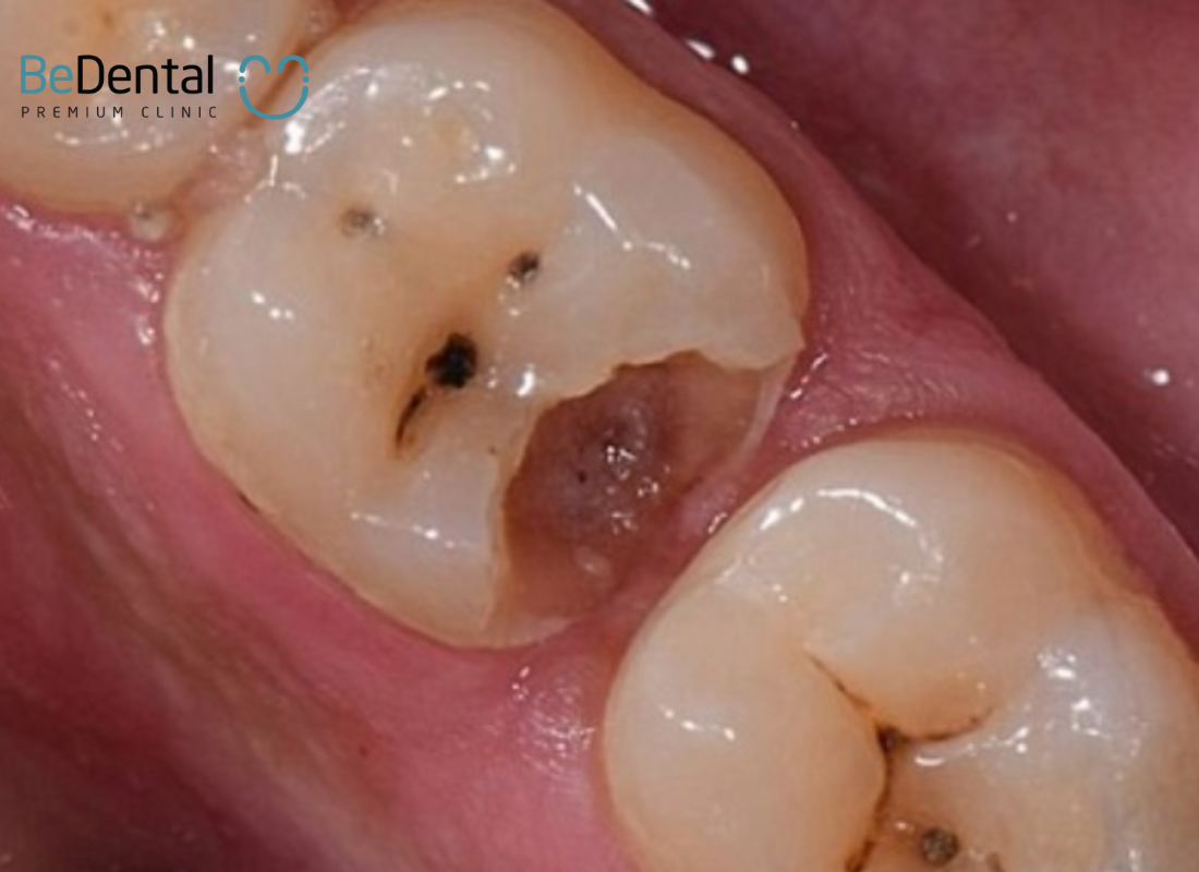 What is a dental cavity
