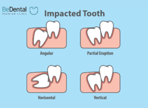 Types of wisdom teeth impacted