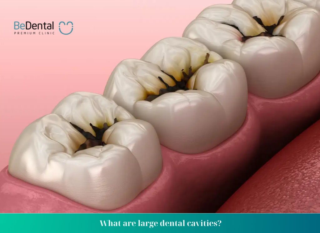 What are large dental cavities? What are the costs to fill large cavity tooth?