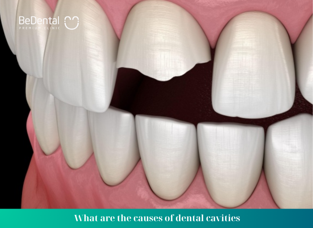 What are the causes of dental cavities