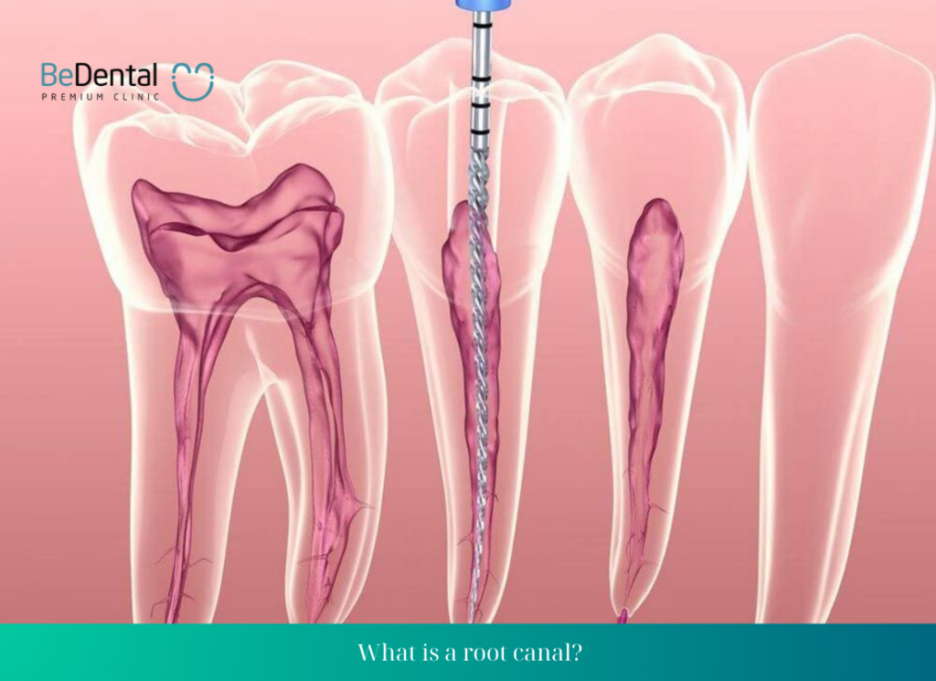 What is a root canal? Symptoms after a root canal.