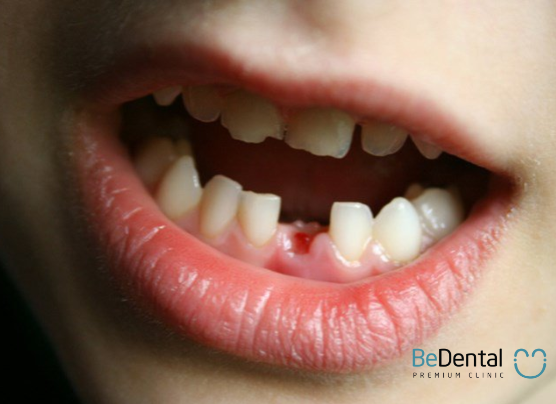Quy trình nhổ răng được tiến hành thế nào? 