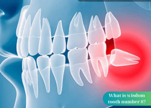 What is wisdom tooth number 8? Should wisdom tooth number 8 be extracted? What if wisdom teeth are not extracted?