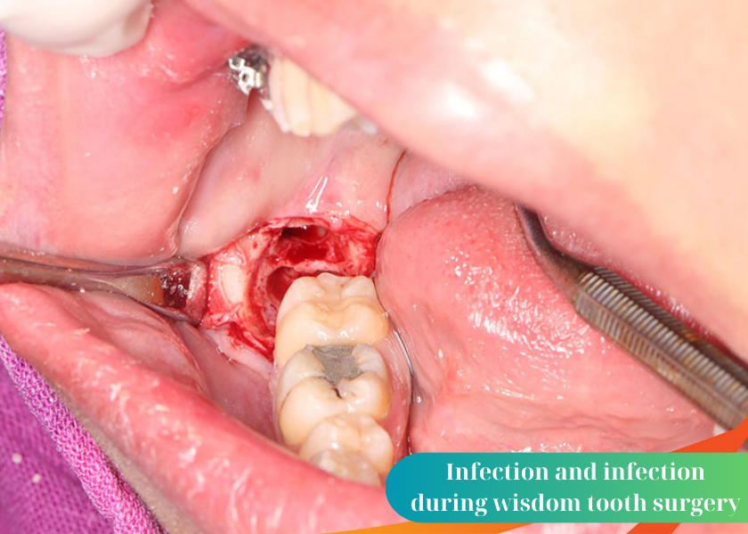 Why do I have a sore throat when I have wisdom teeth removed? How to relieve sore throat after wisdom tooth extraction? 