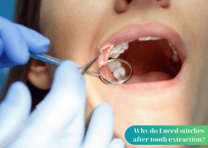 Why do I need stitches after tooth extraction?