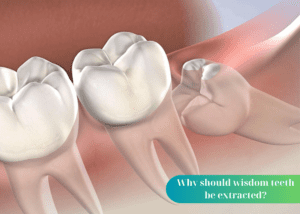 Should 2-4 wisdom teeth be extracted at the same time