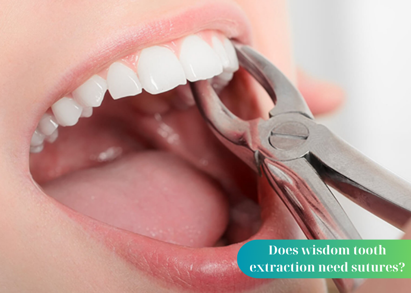 Does wisdom tooth extraction need sutures?