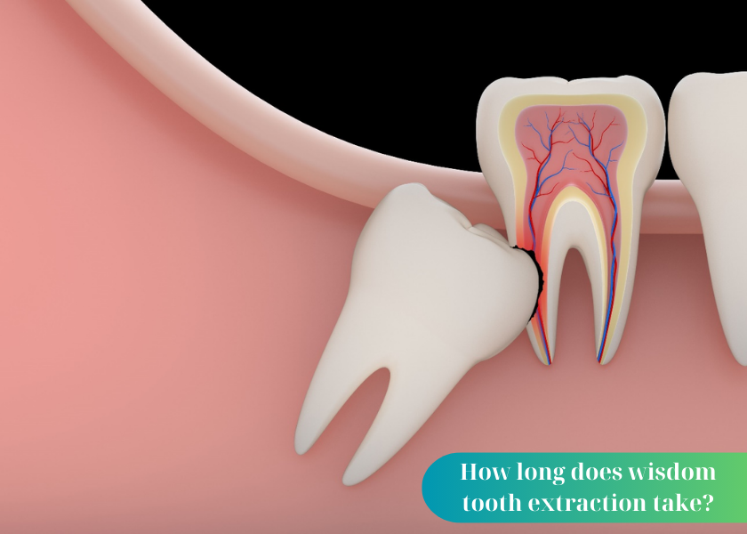 How long does wisdom tooth extraction take? How long does it take for wisdom teeth to heal? How to remove wisdom teeth without pain?