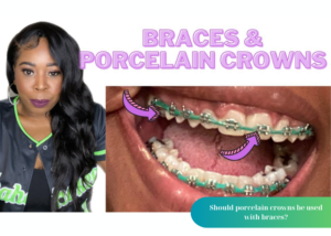 Should porcelain crowns be used with braces