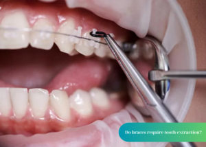 Do braces require tooth extraction