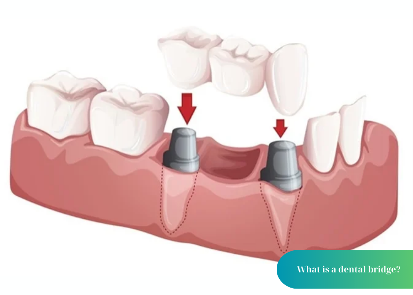 What is a dental bridge?