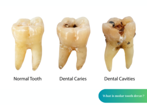 What is molar tooth decay?