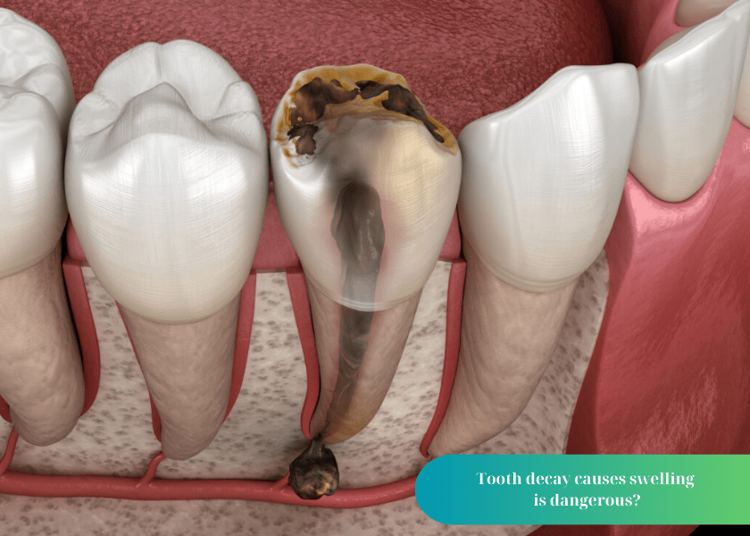 Tooth decay causes swelling is dangerous?