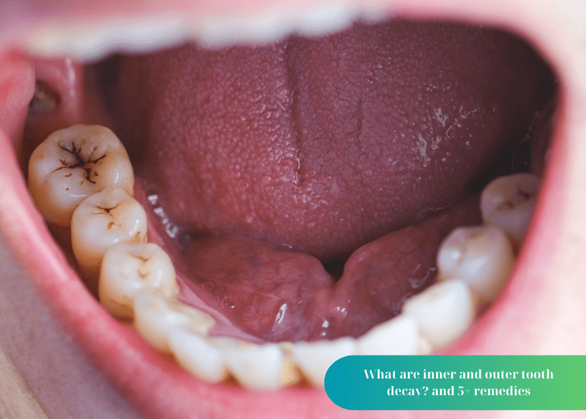 What are inner and outer tooth decay?