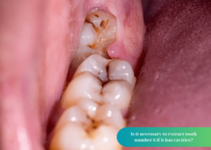 Is it necessary to extract tooth number 6 if it has cavities?