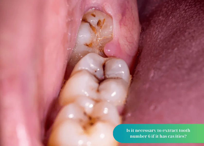 Is it necessary to extract tooth number 6 if it has cavities?