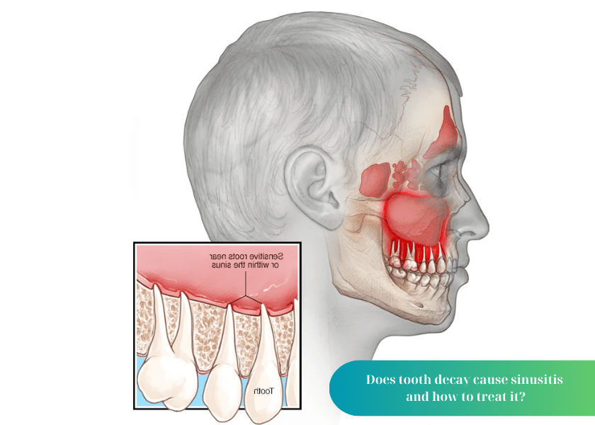 Does tooth decay cause sinusitis?