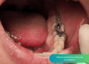 What is tooth decay between two molars?