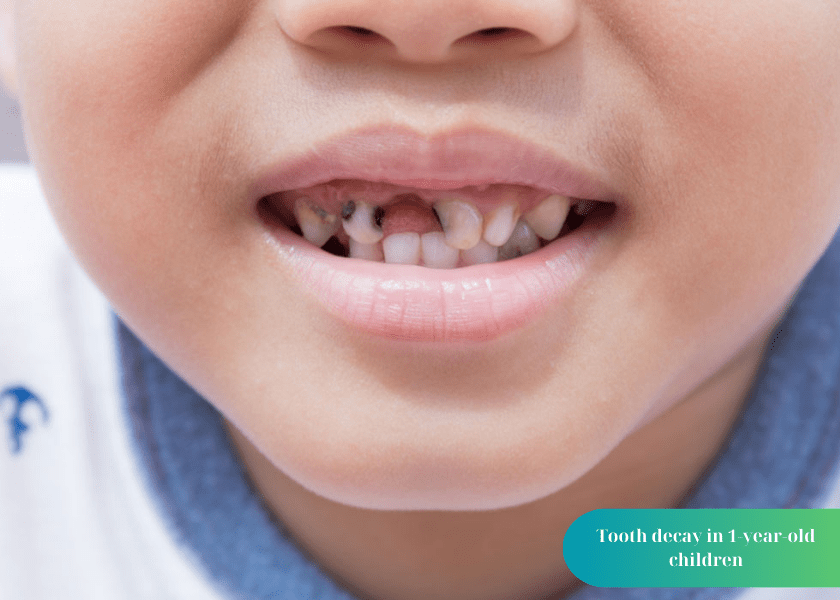 Tooth decay in 1-year-old children